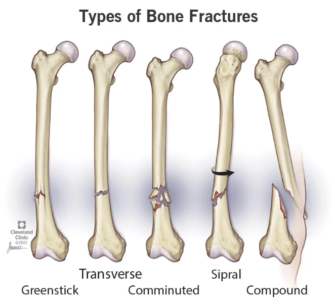 Post Fracture Complications – SP Hospital
